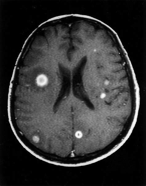 Lesions On The Brain Symptoms Causes Diagnosis And Treatment Mri