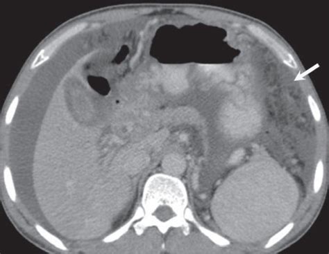 Tuberculosis Axial Contrast Enhanced Ct Scan In A 40 Open I