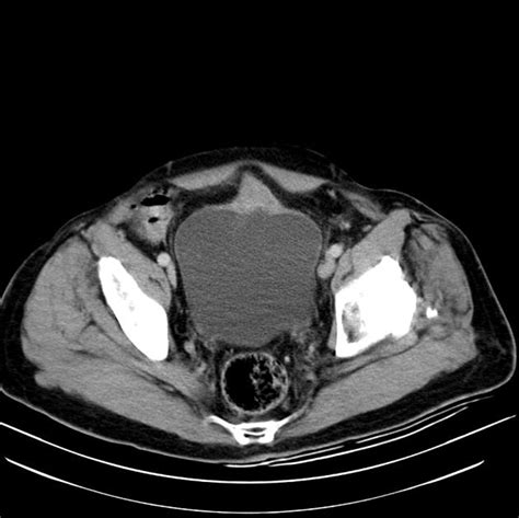 Bladder cancer is a unique disease process in that clinically significant hemorrhage can occur simultaneously with equally significant aberrant clotting. Bladder Cancer - Oncology - Medbullets Step 1