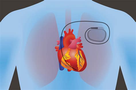 Managing An Arrhythmia Icds And Pacemakers Penn Medicine
