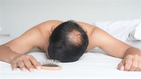 Male Pattern Baldness: Causes, Identification, And ...