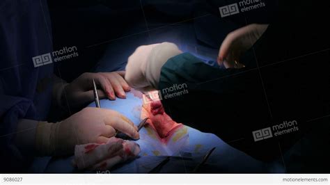 Circumcision Surgery Operation Of A Boy In Hospital Surgeon Room Stock