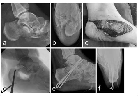 Preoperative A Lateral And B Harris Heel View Radiographs Of An