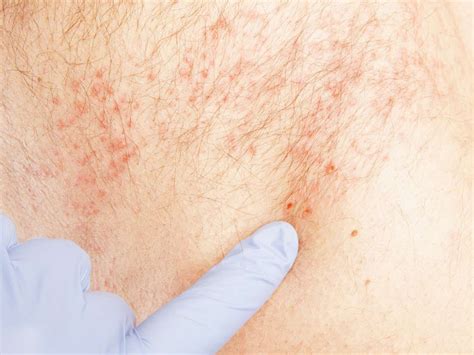 What Does The Early Signs Of Shingles Look Like