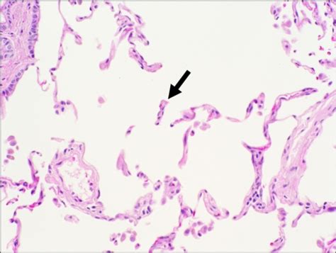 Technological advances have changed this. Histologic features of centrilobular emphysema. A section ...