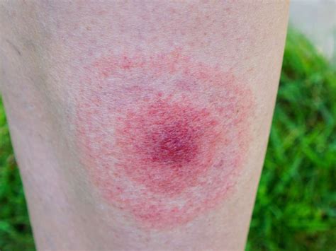 Lyme Disease Rash Symptoms Stages And Identification Lyme Disease