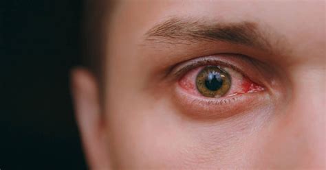 Trustcare Pink Eye Conjunctivitis Symptoms Causes Treatment