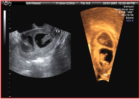 Twin Pregnancy In Uteri With Congenital Anomalies Prenatal Diagnosis