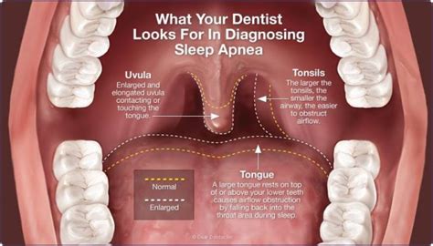 Sleep Apnea Diagnosis Tamworth And Lichfield Tamworth Dental And Implant