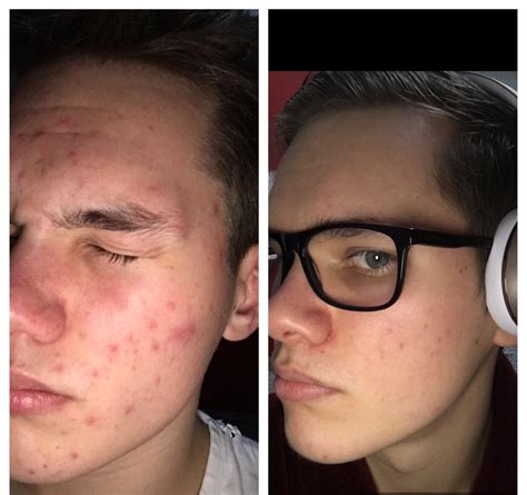 Acne My Months Transformation See Comment For Details R Skincareaddiction