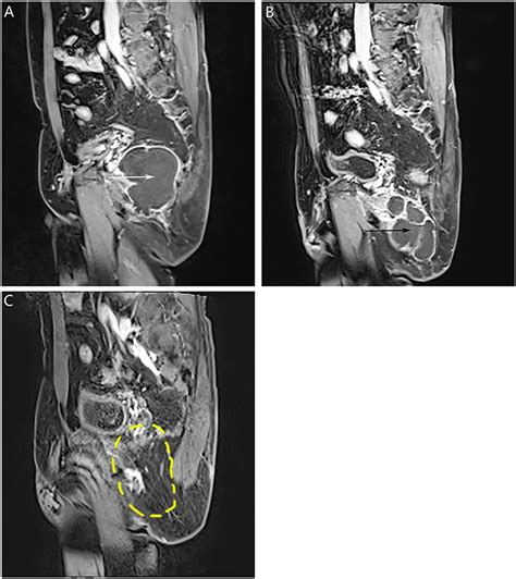 Frontiers Squamous Cell Carcinoma Malignantly Transformed From