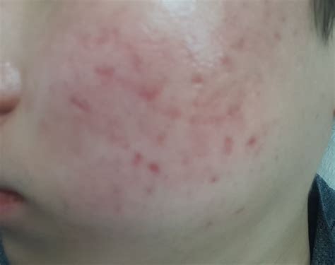 Severe Smooth Red Acne Scars Hyperpigmentation Reddark Marks