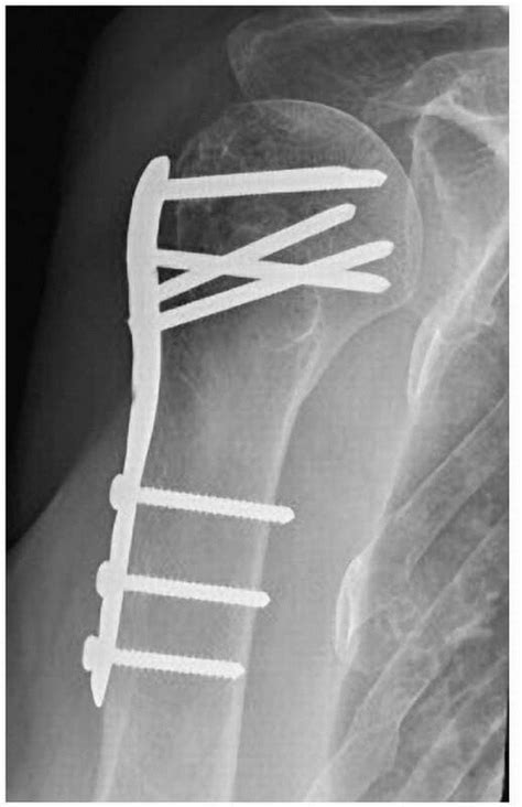 Principles of Osteoporosis and Fragility Fractures ...