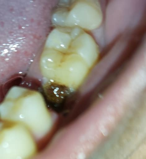 Infection In My Gum Between The Roots Of My Molar