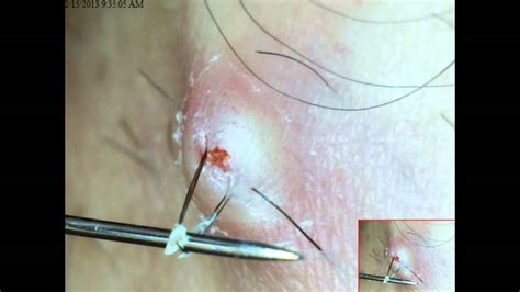 Herpes simplex lesions and tiny abscesses caused by ingrown hair look very similar at the first glance. pilonidal cyst pictures - pictures, photos