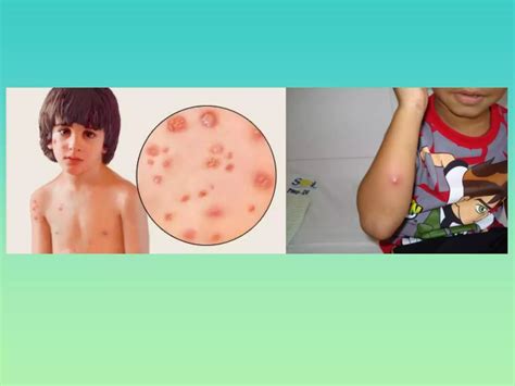 Fluxograma para diagnóstico das doenças exantemáticas na infância