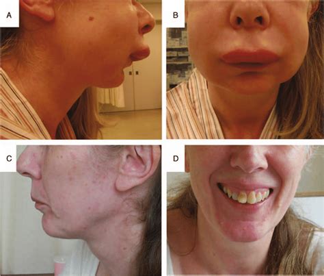 Causes, triggers, diagnosis, treatment, and prognosis information are provided. Photographs of a patient with hereditary angioedema (Case 1). Facial... | Download Scientific ...