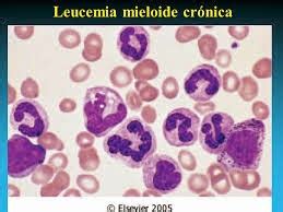 We did not find results for: LEUCEMIA MIELOIDE CRÓNICA: Diagnósticos (por Ziyi Xia)