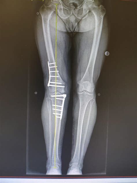 Double Osteotomy Of The Knee The Right Decision