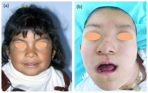 Ijms Free Full Text Unusual Trisomy X Phenotype Associated With A Concurrent Heterozygous
