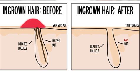 Hair removal is the most common treatment for people struggling with ingrown hairs, including laser hair remova l. Ingrown hair - The Angel Laser Clinic London
