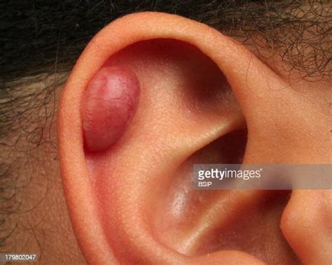 Keloid Scar Ear Piercing Keloid Photo Dactualité Getty Images