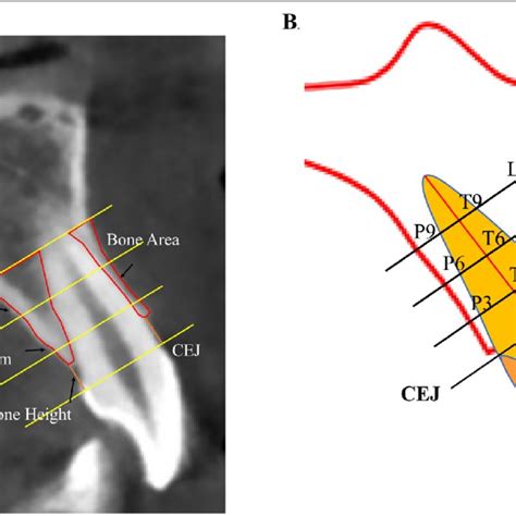 Changes In The Labial And Palatal Alveolar Bone Area In Central And