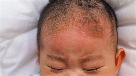 seborrheic dermatitis scalp infant