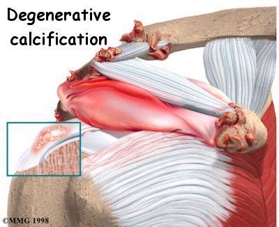 Calcific Tendonitis Of The Shoulder Anatomy Degenerative Calcification Tendinitis Shoulder