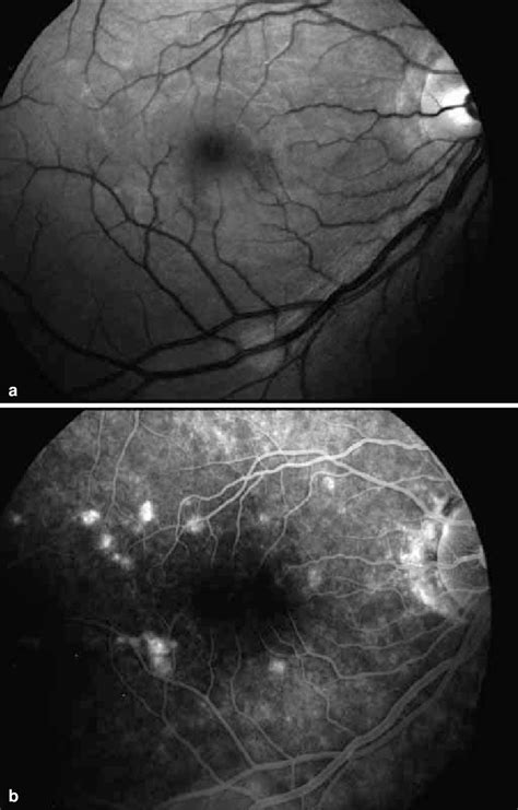 A Red Free Fundus Photograph Of The Right Eye Revealing Discrete