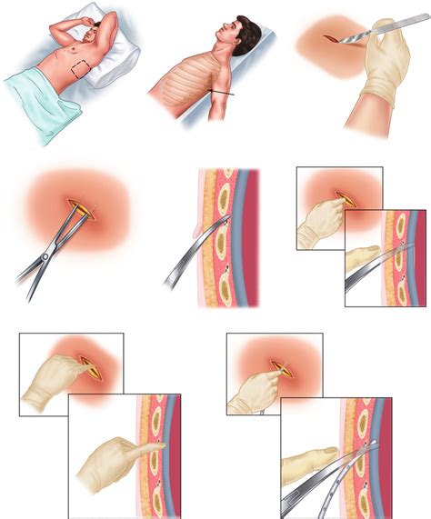 Apply ordered amount of suction. Chest Tube Thoracostomy | SpringerLink