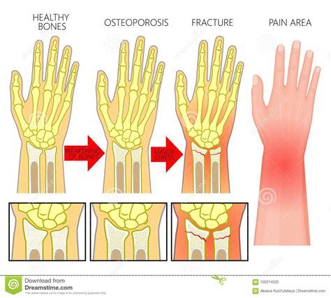 Osteoporosi Di Frattura Di Fracture_Wrist Dell'osso ...