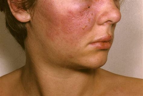 Systemic Lupus Erythematosus Sle Simptom Punca Diagnosis Faktor