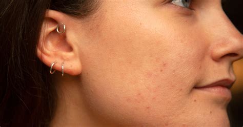 Jawline Spots Acne Best Spot Treatments