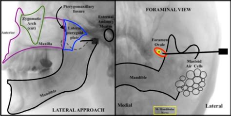 Fluoroscopically Guided Mandibular Nerve Block A Modified Lateral