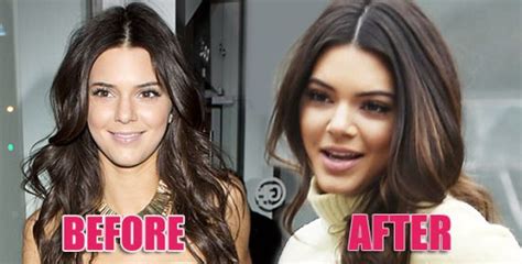 See more of kendall jenner on facebook. Mother Nose Best? Kendall Jenner Had Nose Job, Says Doc ...