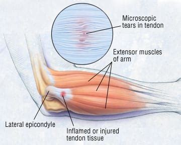 Tennis elbow is typically diagnosed by a physical exam, though diagnostic imaging may be administered to rule out other types of elbow or forearm injuries that patients often see their primary care doctor first for suspected tennis elbow, and the primary care doctor can often provide treatment. Patient Basics: Tennis Elbow (Lateral Epicondylitis) | 2 ...