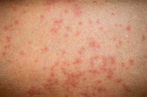 Allergic Rash On Right Arm Stock Image Image Of Allergic 126947259