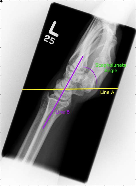 Scapholunate Ligament Disruption Sport Med School