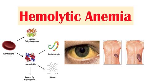 Hemolytic Anemia Youtube