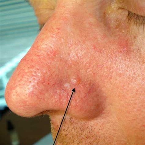 Skin Cancer On Face White Spot