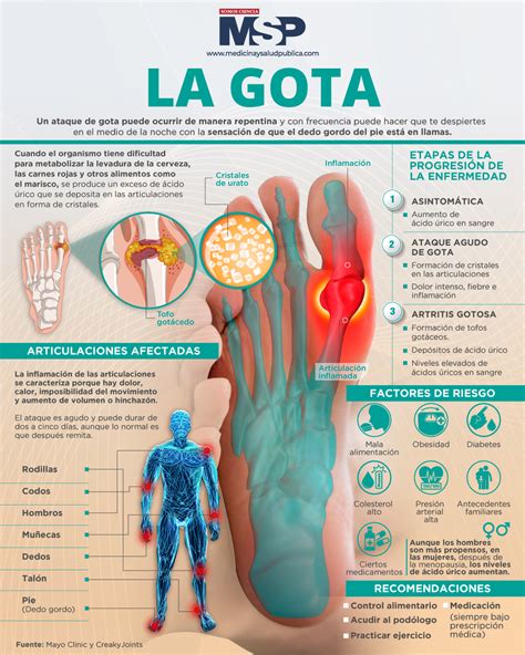 LA GOTA Artritis Gotosa Infografia By MSP MED TAC International Corp