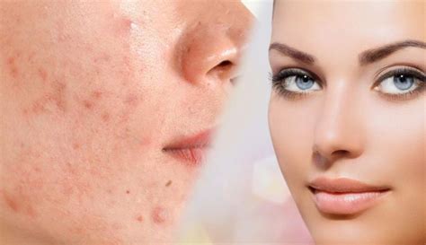 How To Get Rid Of Acne Scars Types Of Acne Scars