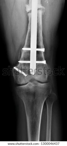 Radiograph Distal Femur Fracture Stock Photo 1300046437 Shutterstock
