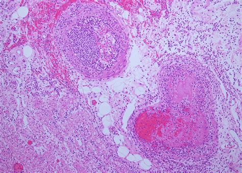 Granulomatosis With Polyangiitis With Intestinal Involvement