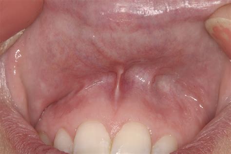Photos Showing Self Oral Cancer Exam And Information Julie M Gillis