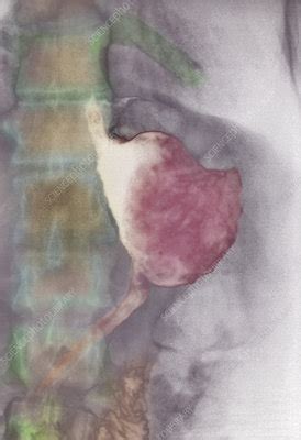 Cancer sometimes develops in the stomach. Stomach cancer treatment, X-ray - Stock Image - M725/0315 ...