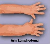 A Step By Step Guide To Arm Lymphedema Exercises Lymphatic Massage