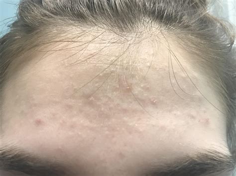 How to get rid of tiny bumps on face, NISHIOHMIYA-GOLF.COM