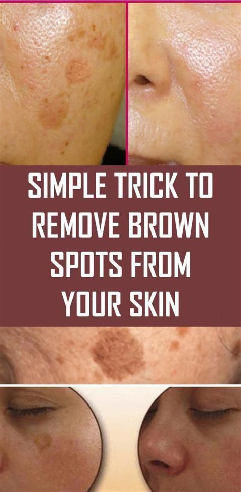 How To Get Rid Of Black Spots On Face Brownspotsonface Spots On Face
